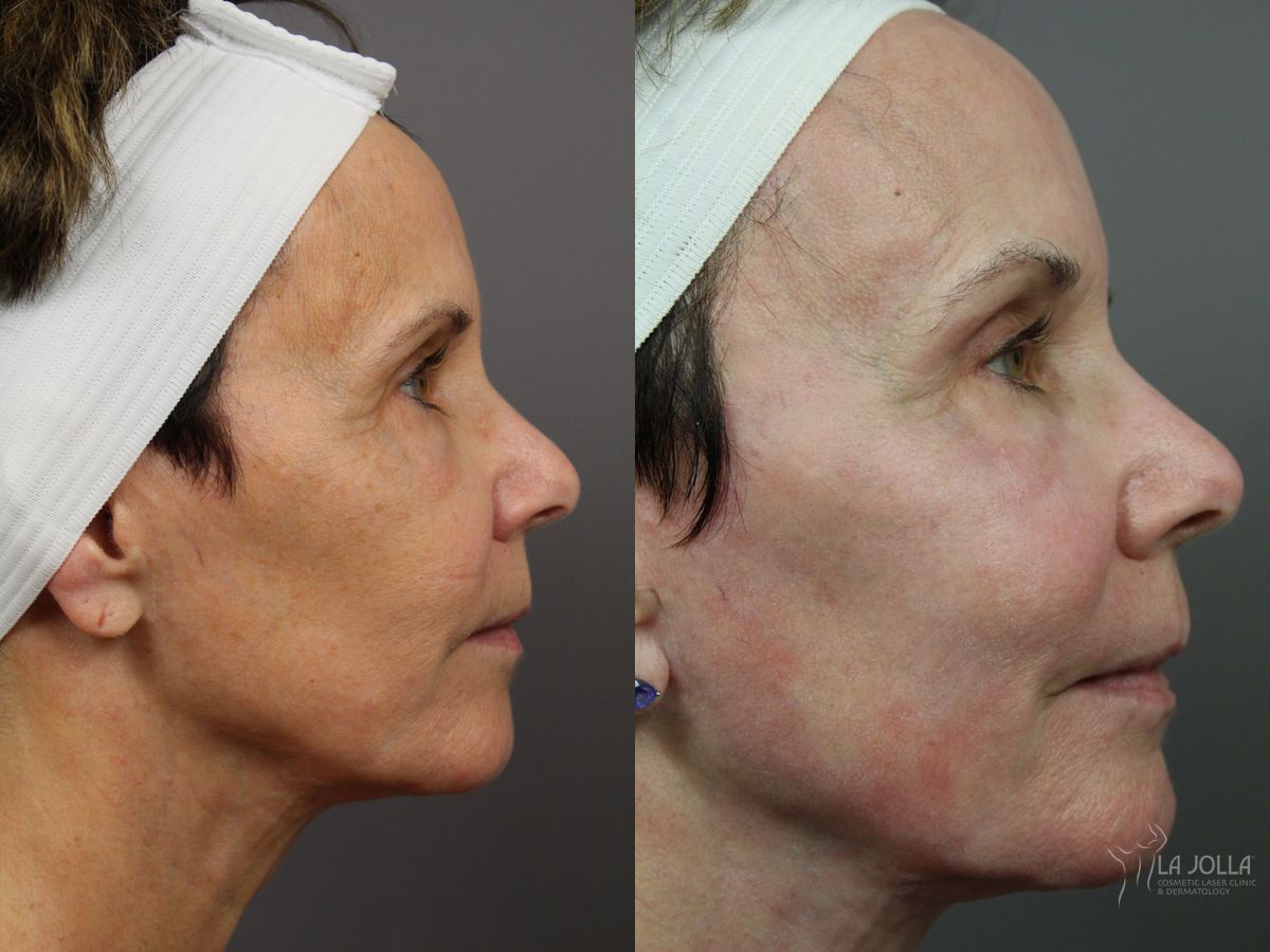 Before and after SP Dynamis case 36354