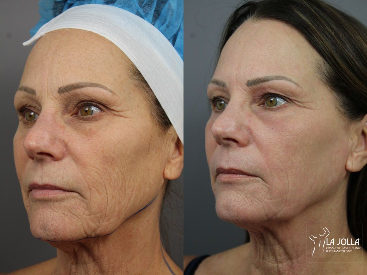 Before and after SP Dynamis case 36355