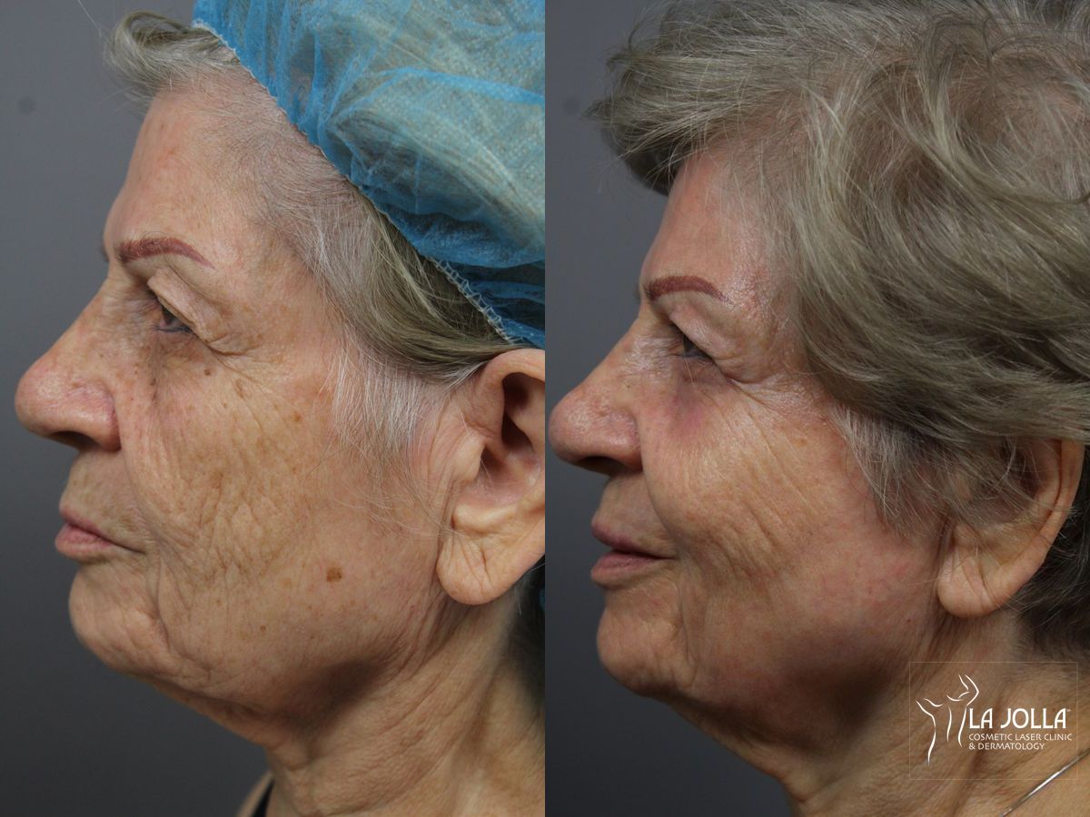 Before and after SP Dynamis case 36368