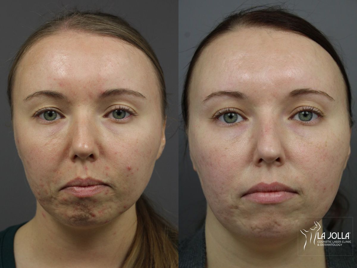 Before and after SP Dynamis case 36377