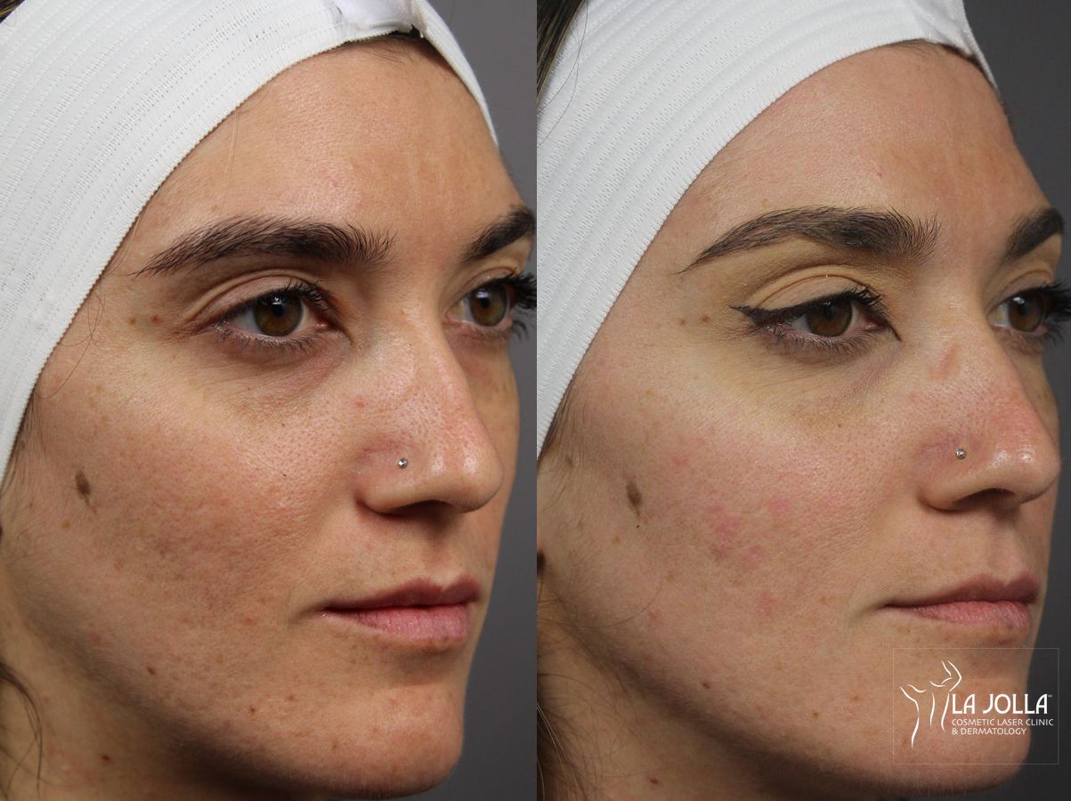 Before and after SP Dynamis case 36381