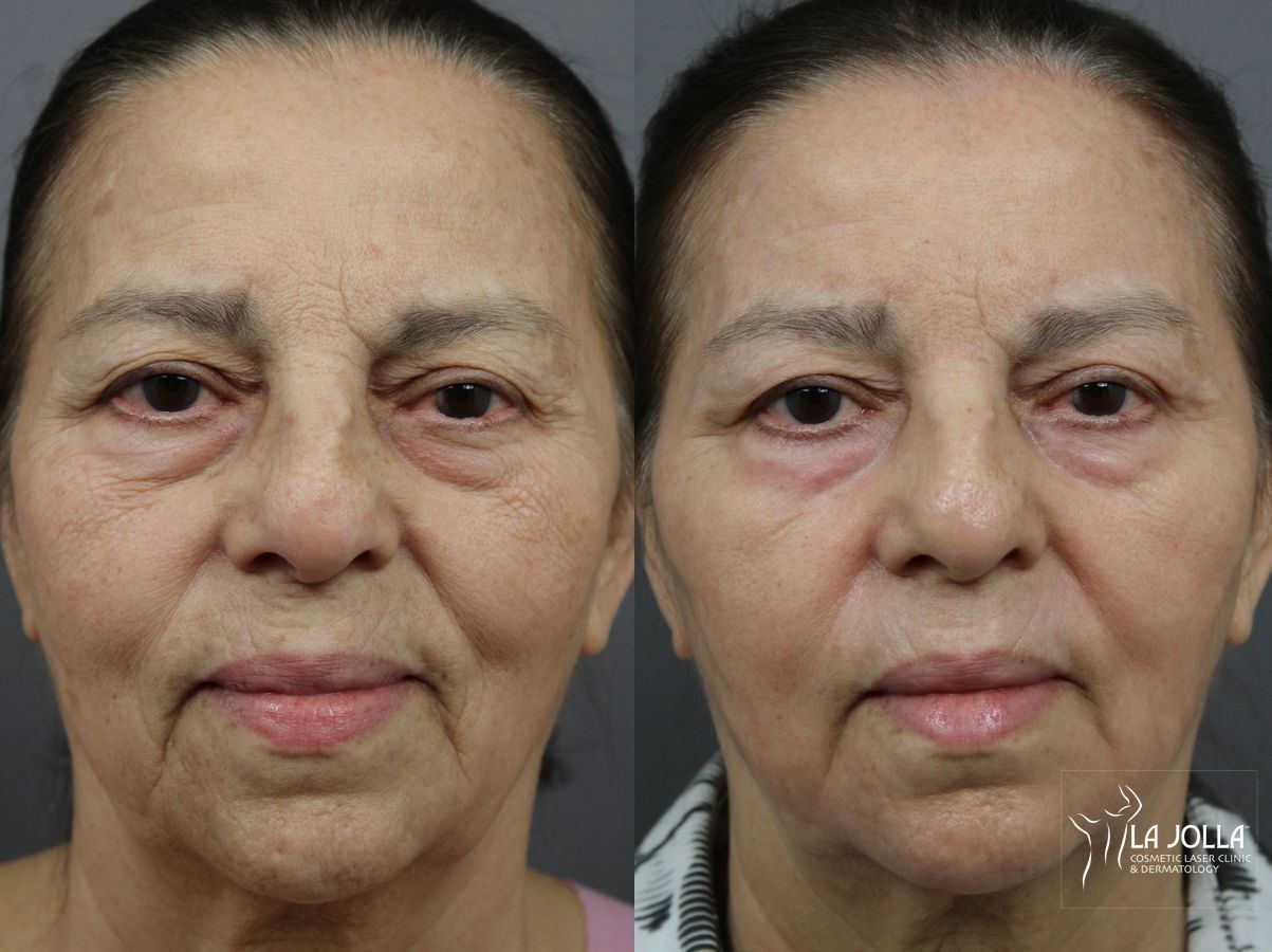 Before and after SP Dynamis case 36283 - Angle 2