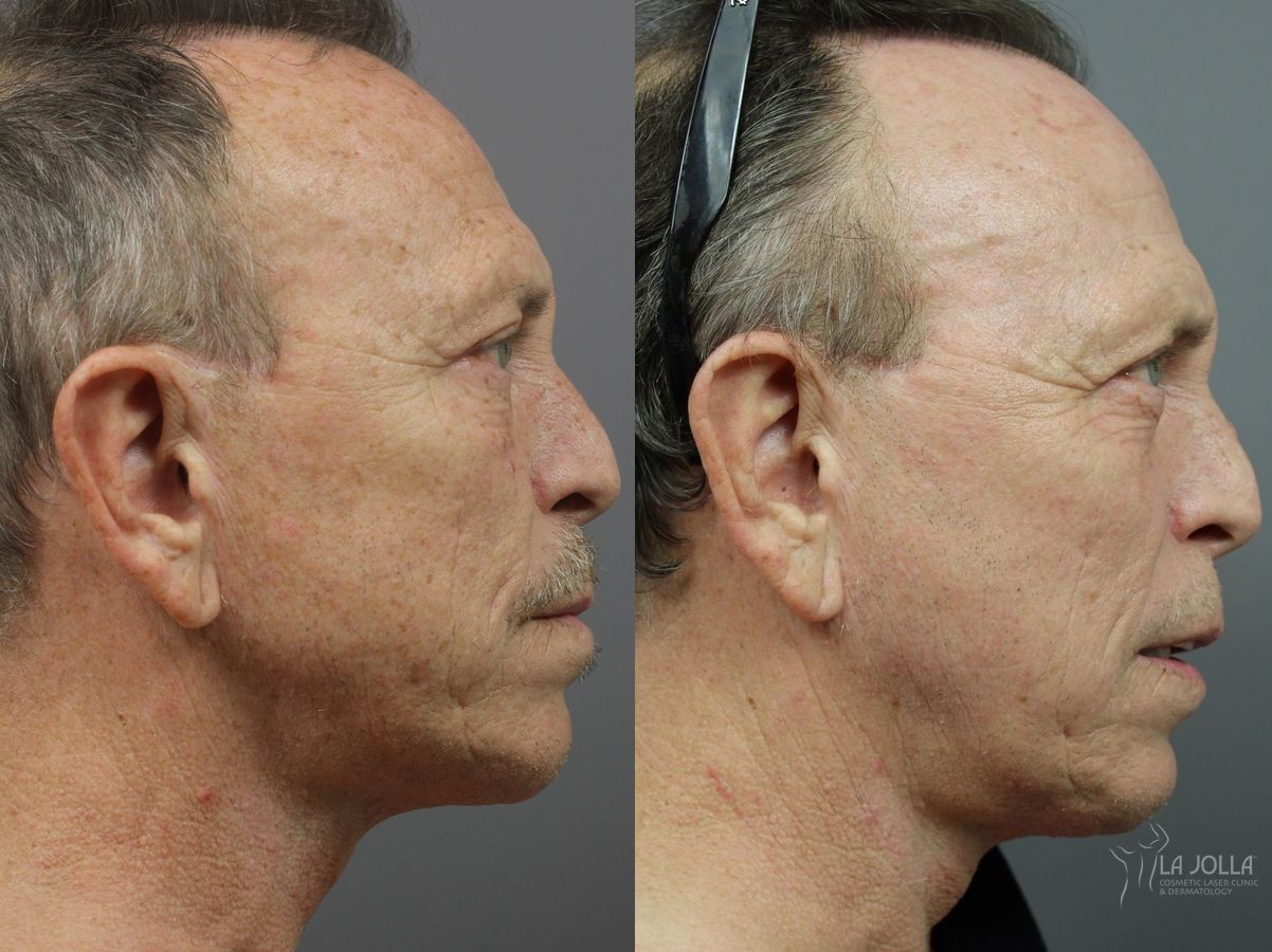 Before and after SP Dynamis case 36295