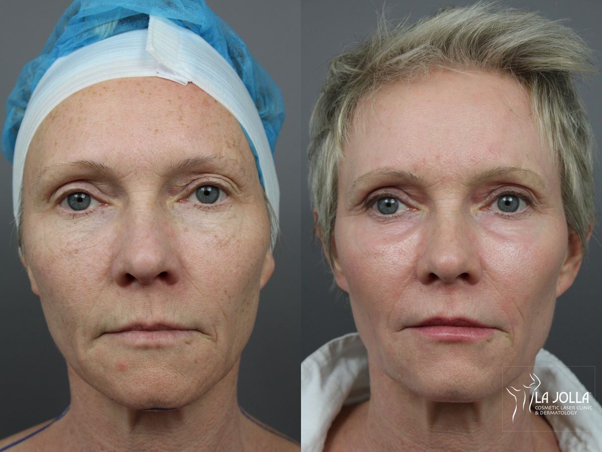 Before and after SP Dynamis case 36379