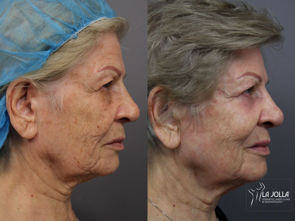 Before and after SP Dynamis case 36369