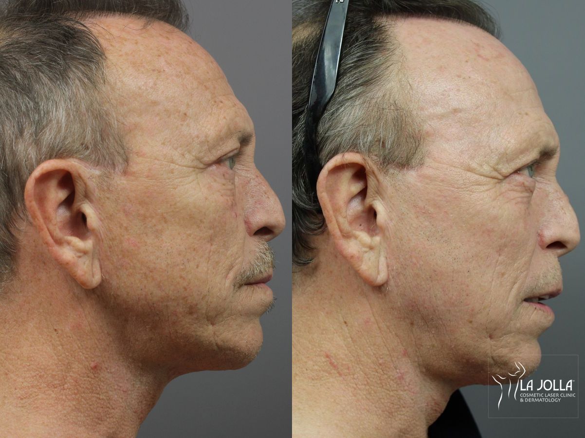 Before and after SP Dynamis case 36295