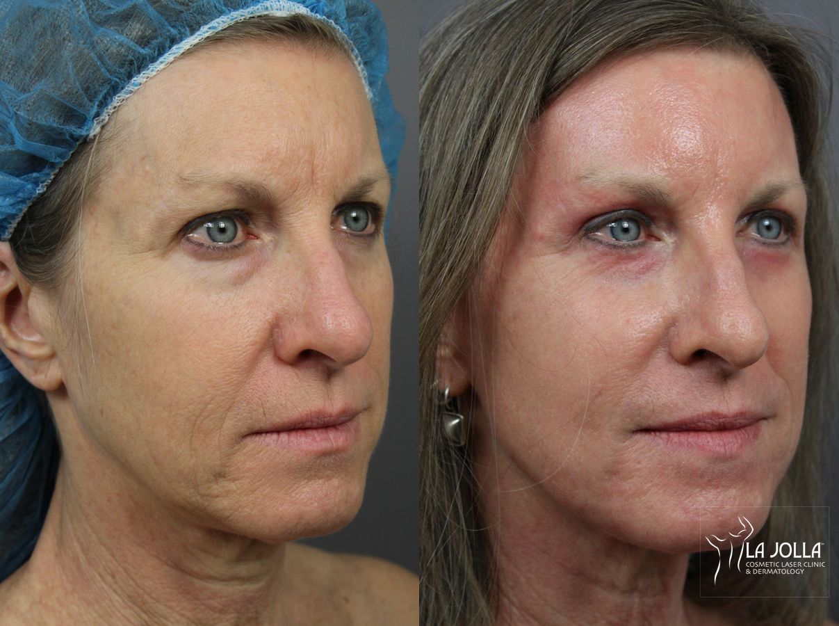 Before and after SP Dynamis case 36242 - Angle 2