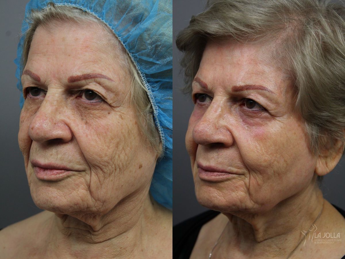 Before and after SP Dynamis case 36375