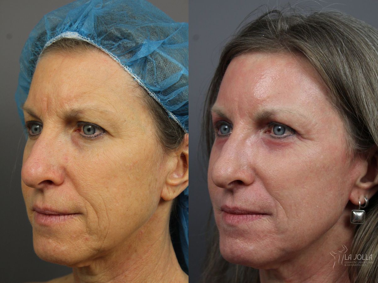 Before and after SP Dynamis case 36242