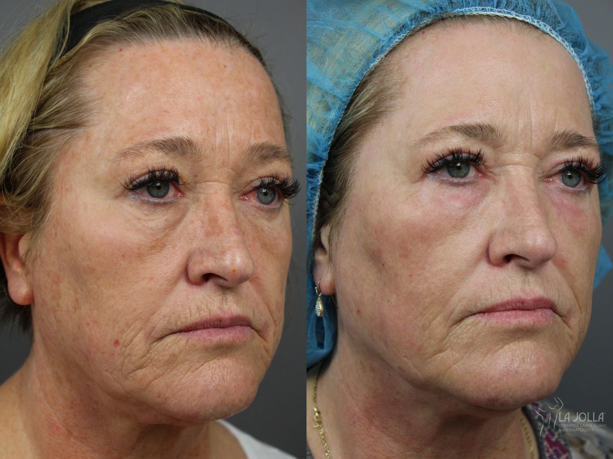 Before and after SP Dynamis case 36338