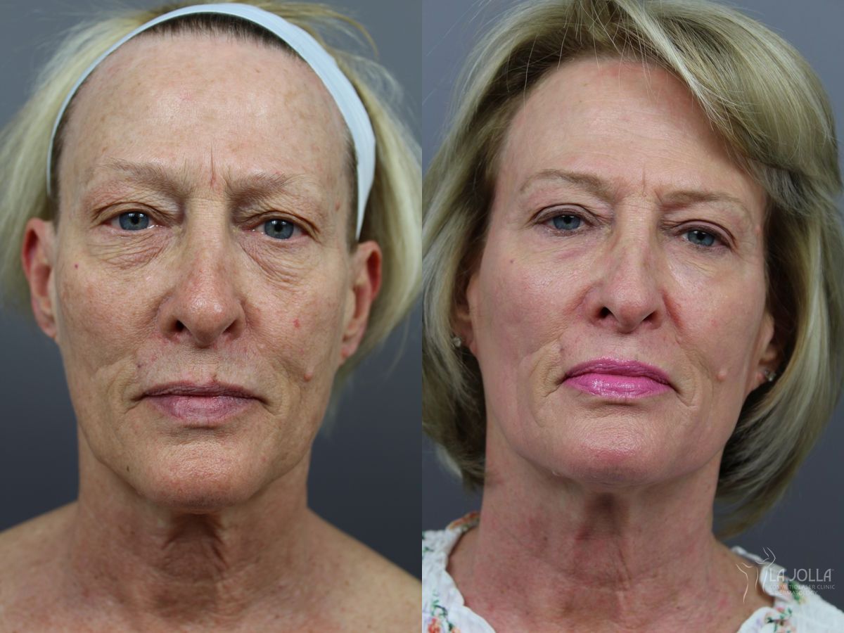 Before and after SP Dynamis case 36348