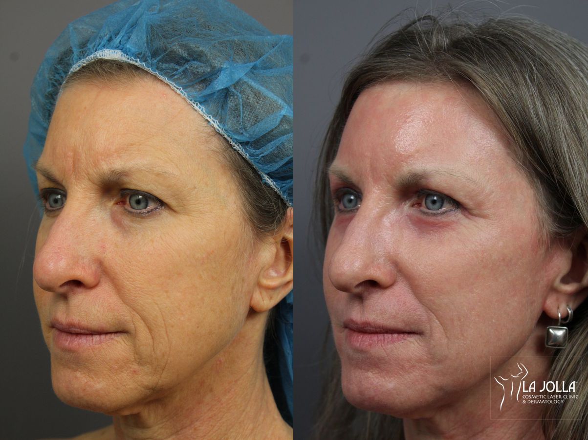 Before and after SP Dynamis case 36242