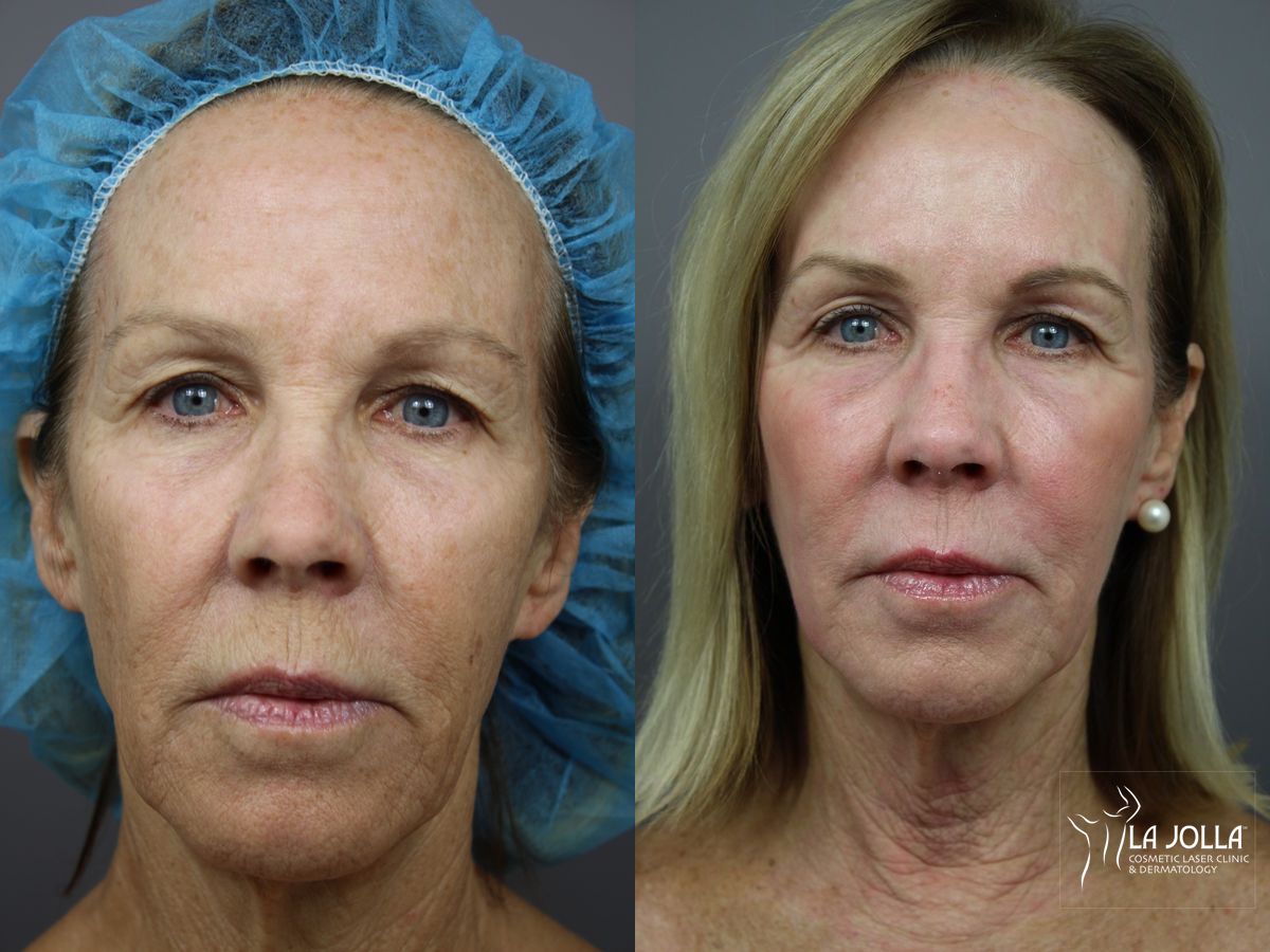 Before and after SP Dynamis case 36337