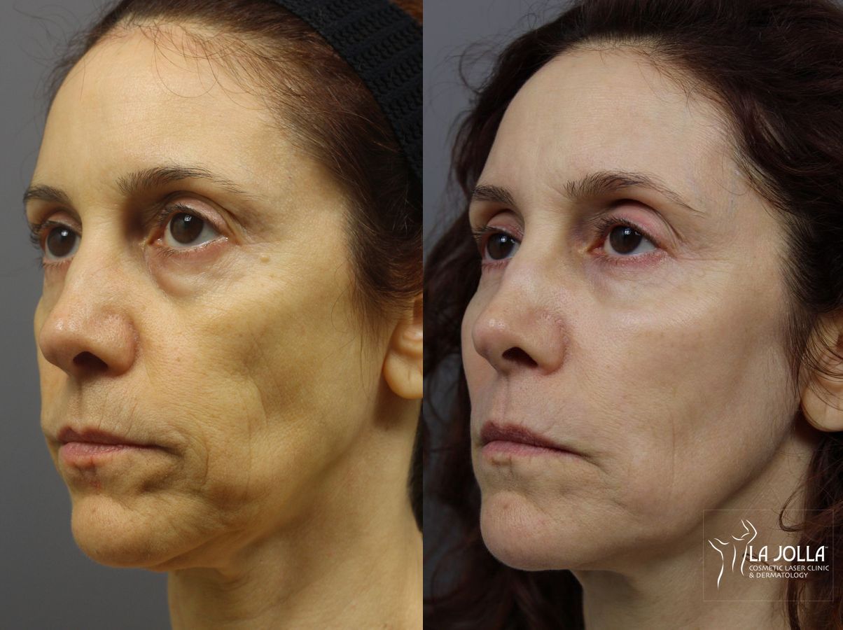 Before and after SP Dynamis case 36218