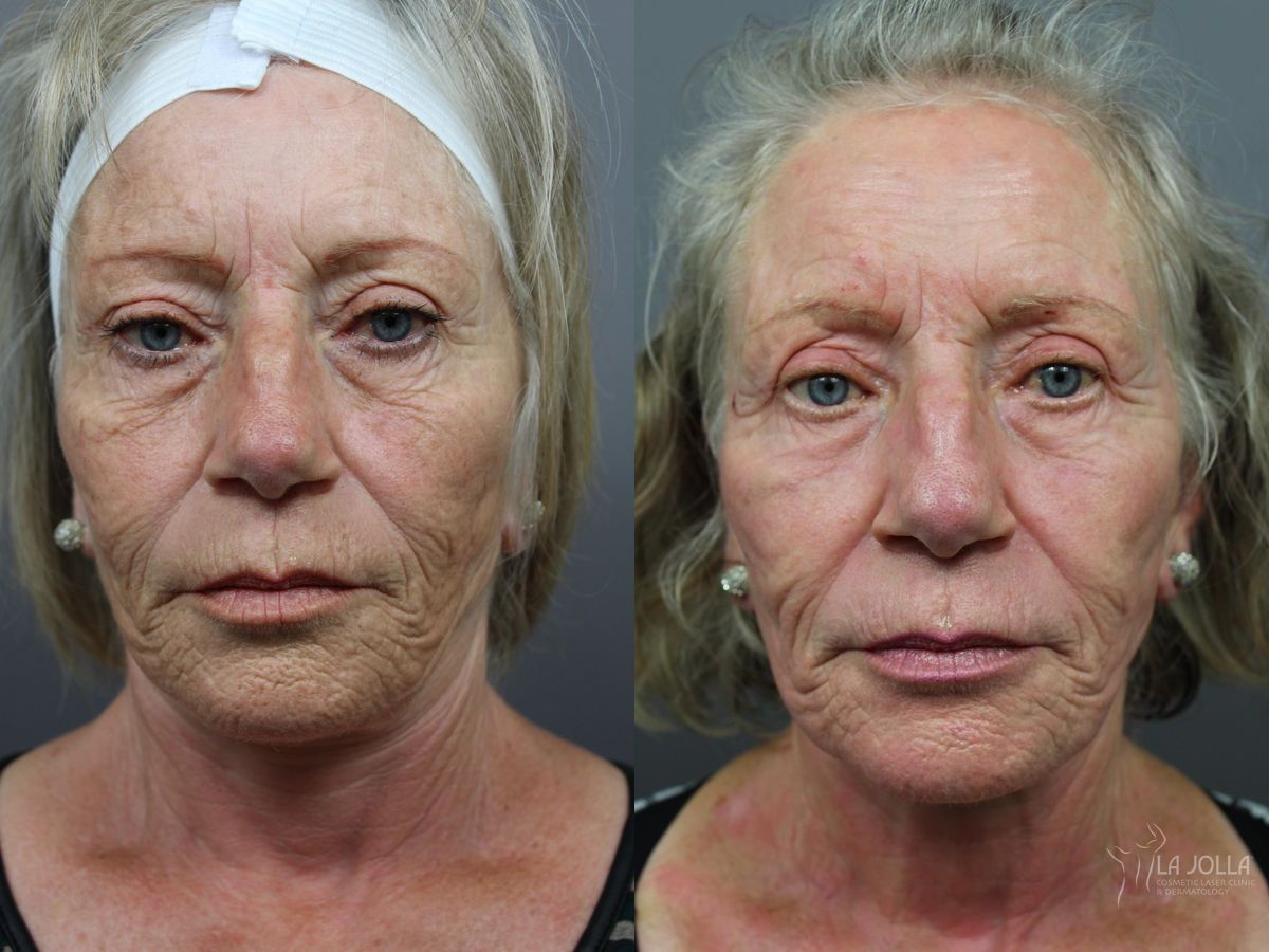 Before and after SP Dynamis case 36312