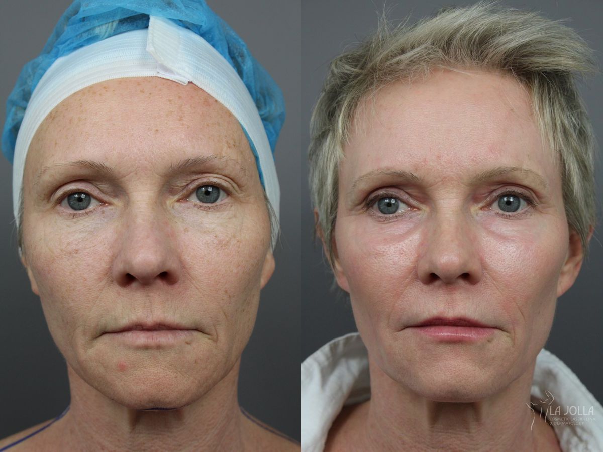 Before and after SP Dynamis case 36379