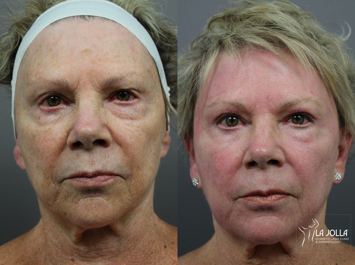 Before and after SP Dynamis case 36089