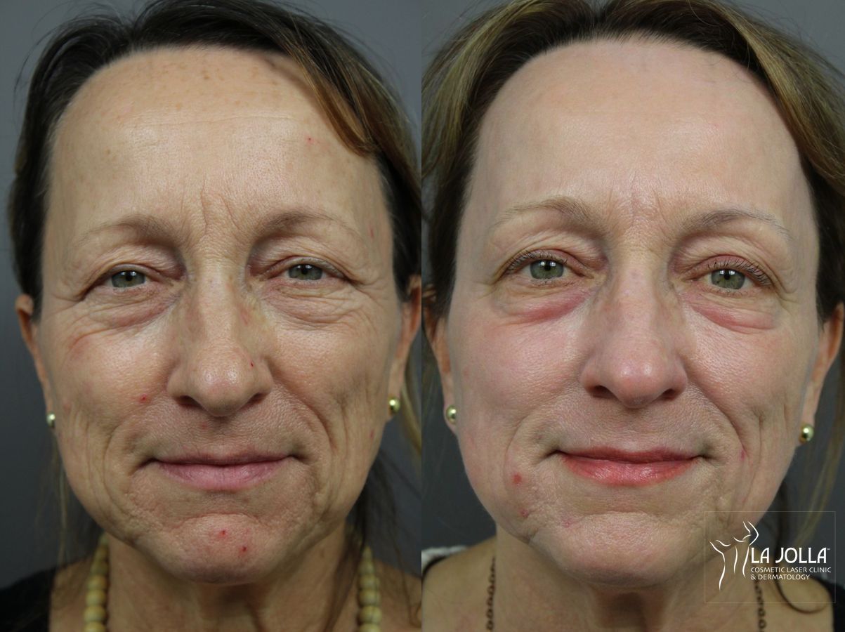 Before and after SP Dynamis case 36168