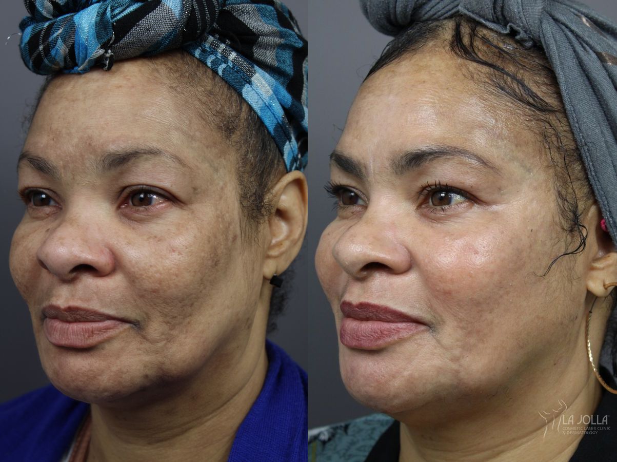 Before and after SP Dynamis case 36227