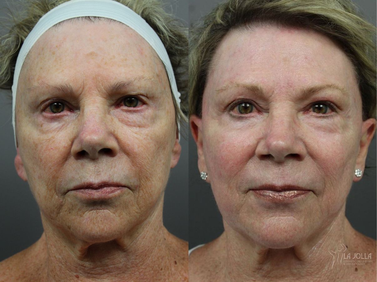 Before and after SP Dynamis case 36089