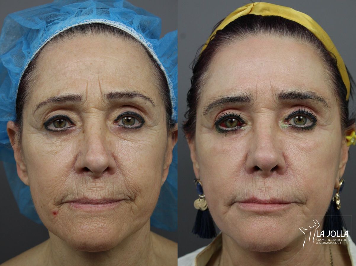 Before and after SP Dynamis case 36156