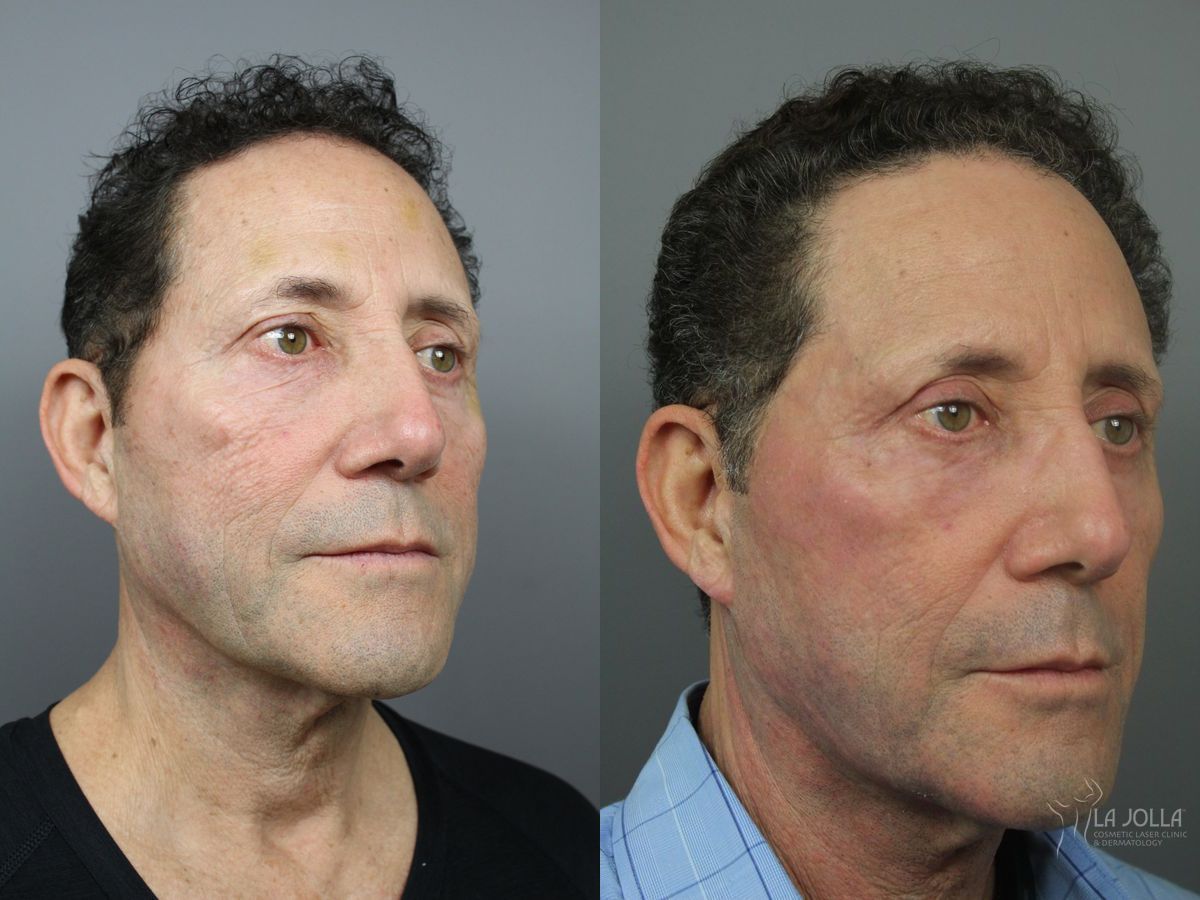 Before and after SP Dynamis case 36325