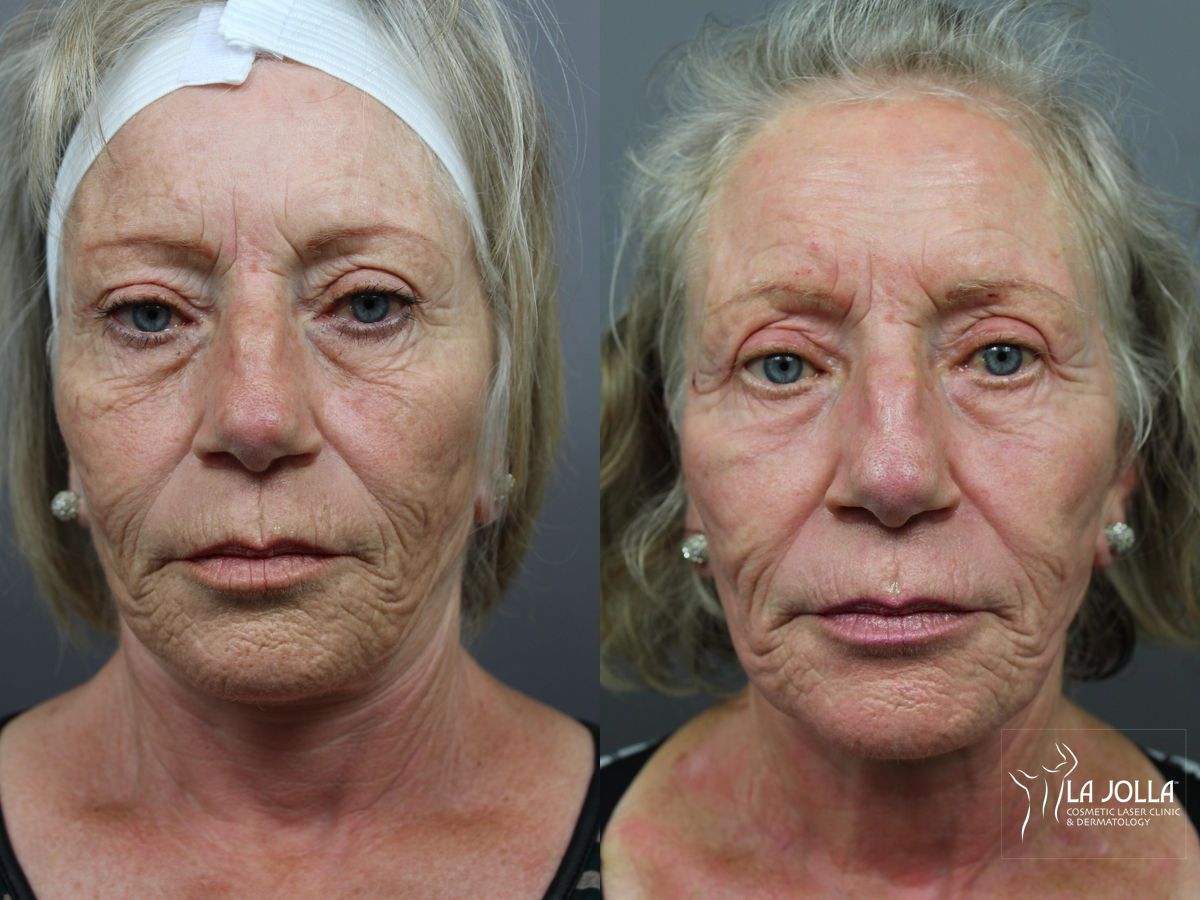 Before and after SP Dynamis case 36312