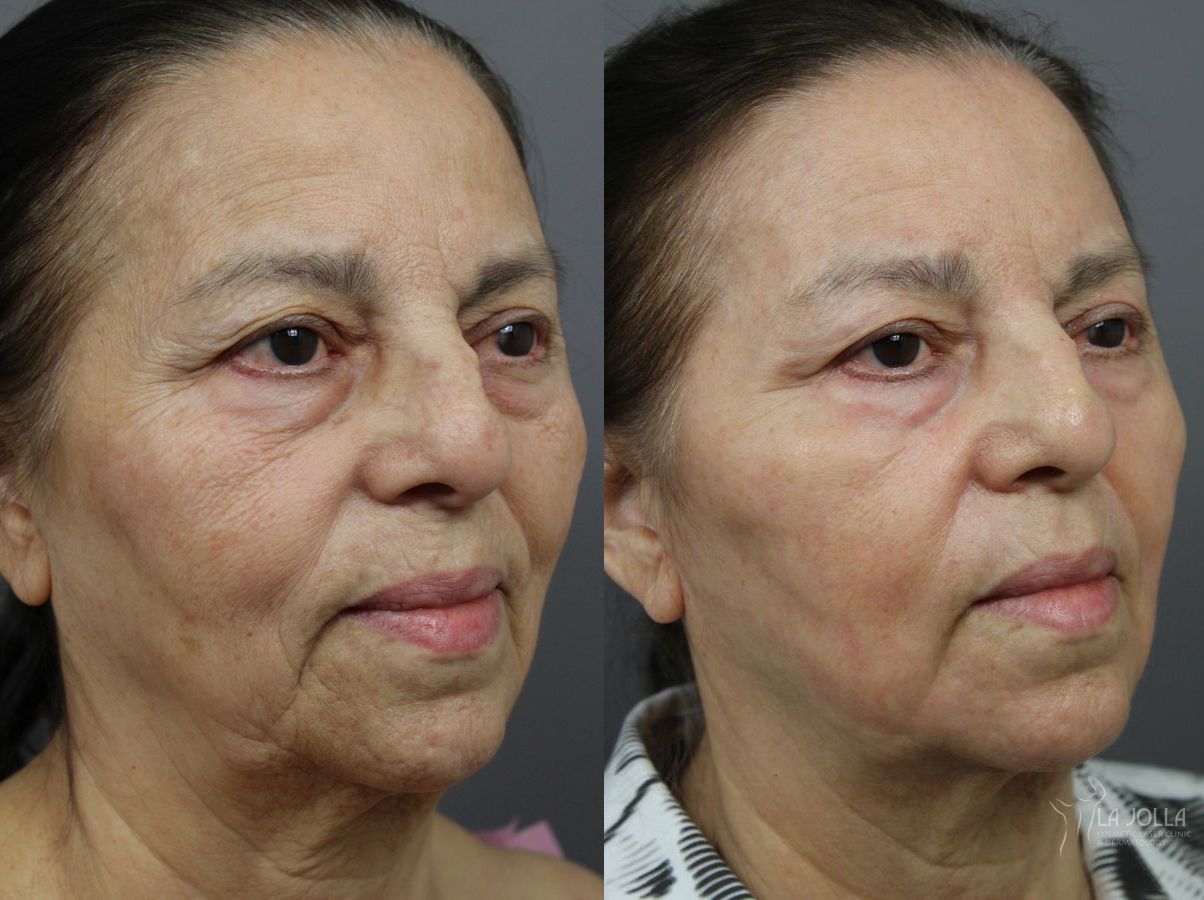 Before and after SP Dynamis case 36283
