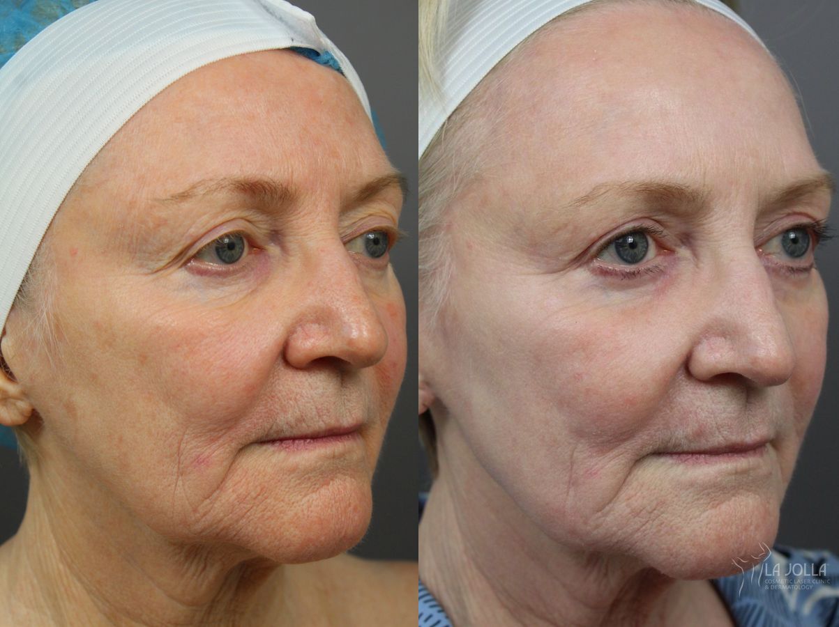 Before and after SP Dynamis case 36262 - Angle 3