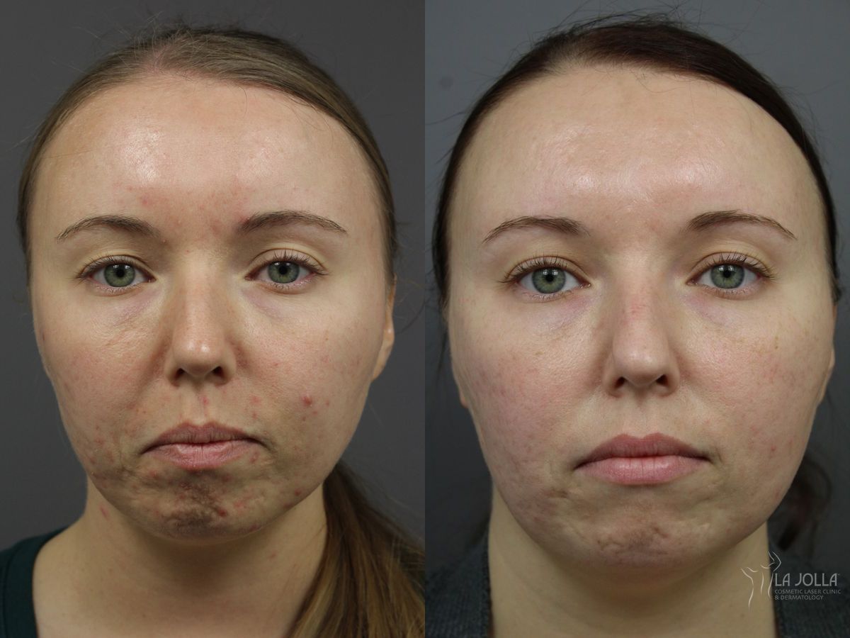 Before and after SP Dynamis case 36377