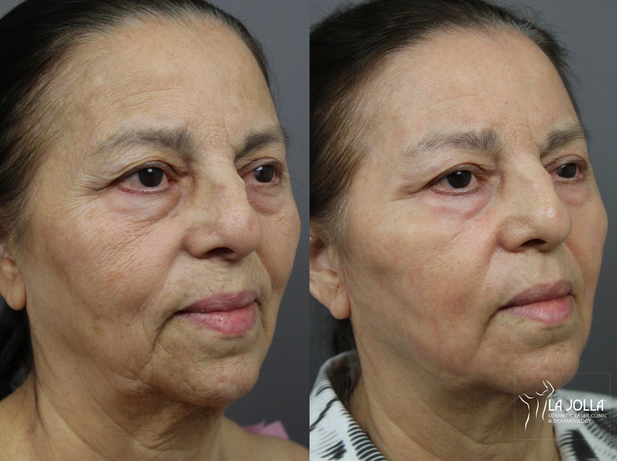 Before and after SP Dynamis case 36283