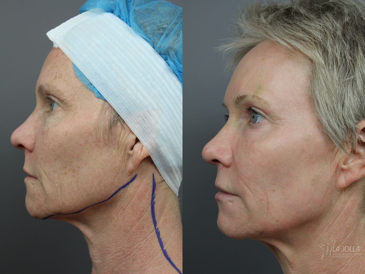 Before and after SP Dynamis case 36374