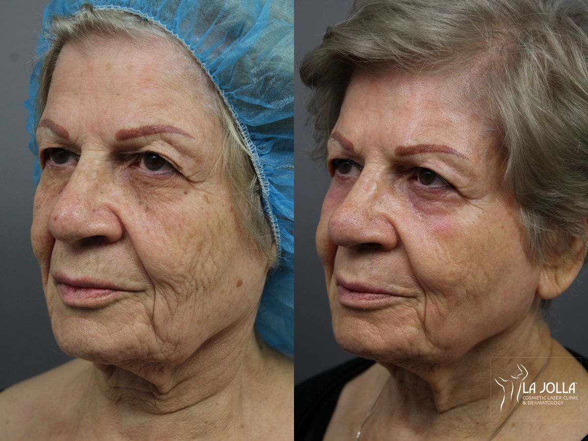 Before and after SP Dynamis case 36375