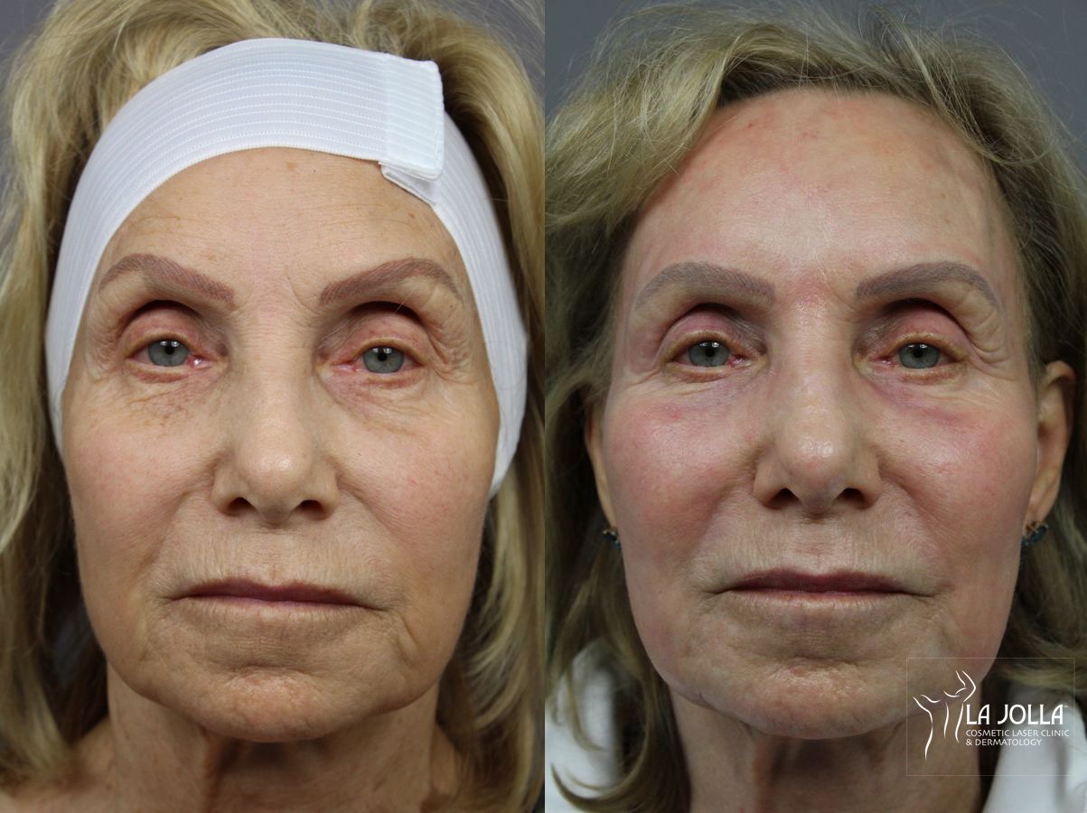 Before and after SP Dynamis case 36286
