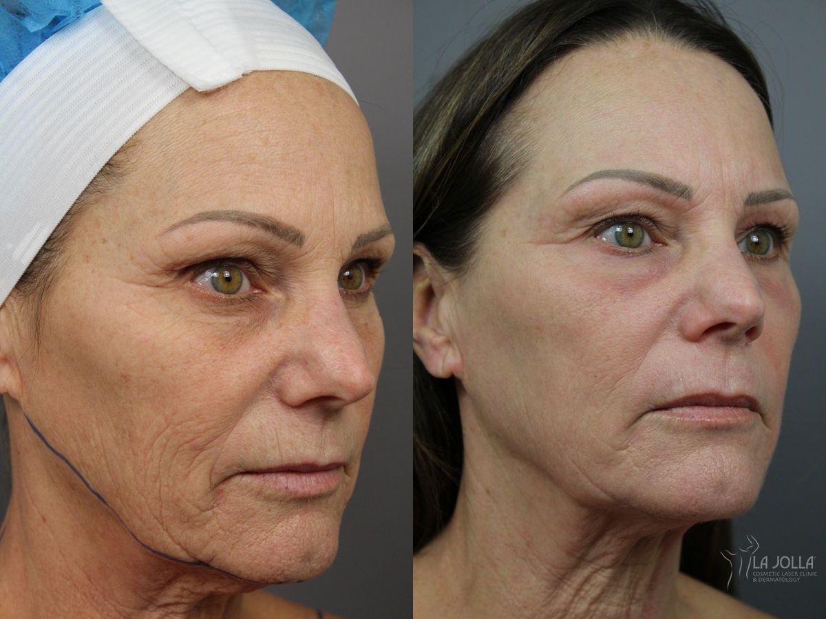 Before and after SP Dynamis case 36359