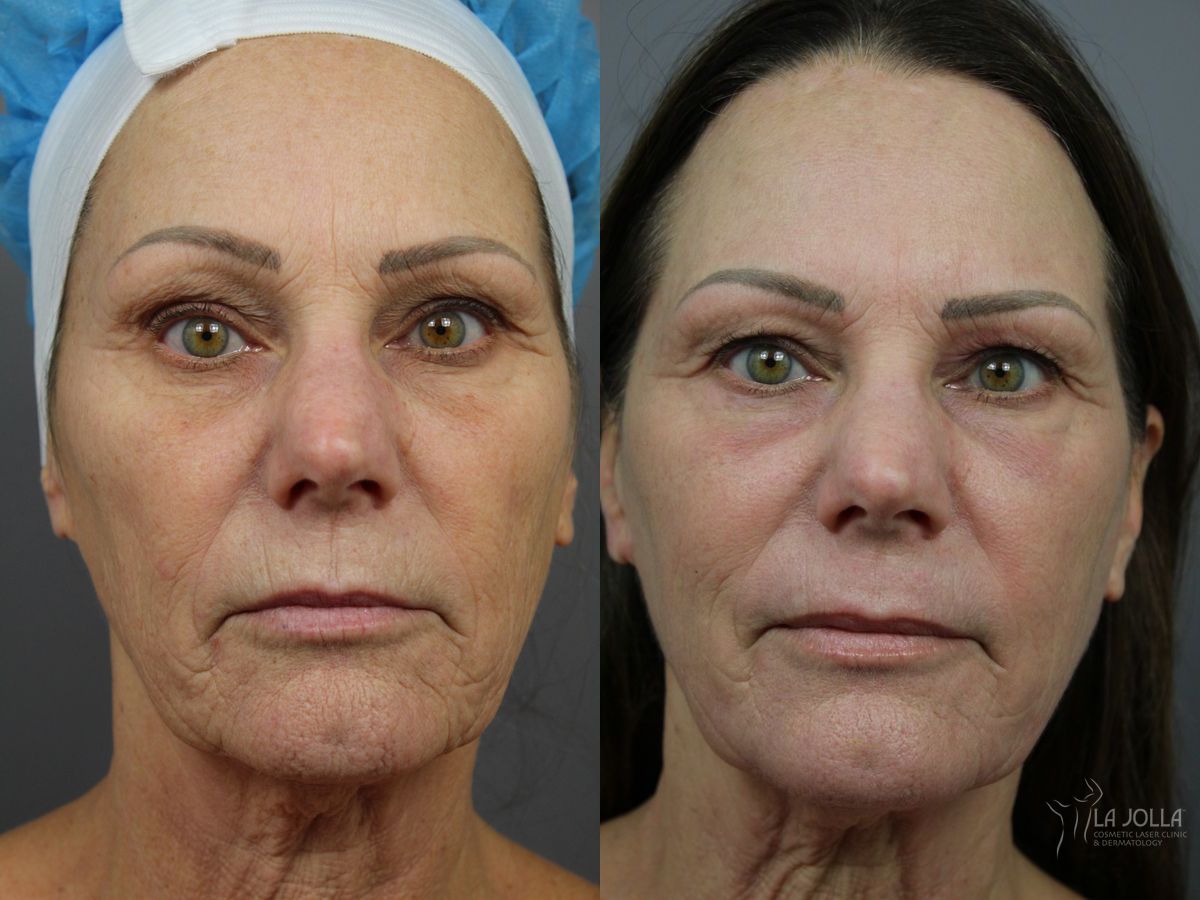 Before and after SP Dynamis case 36358