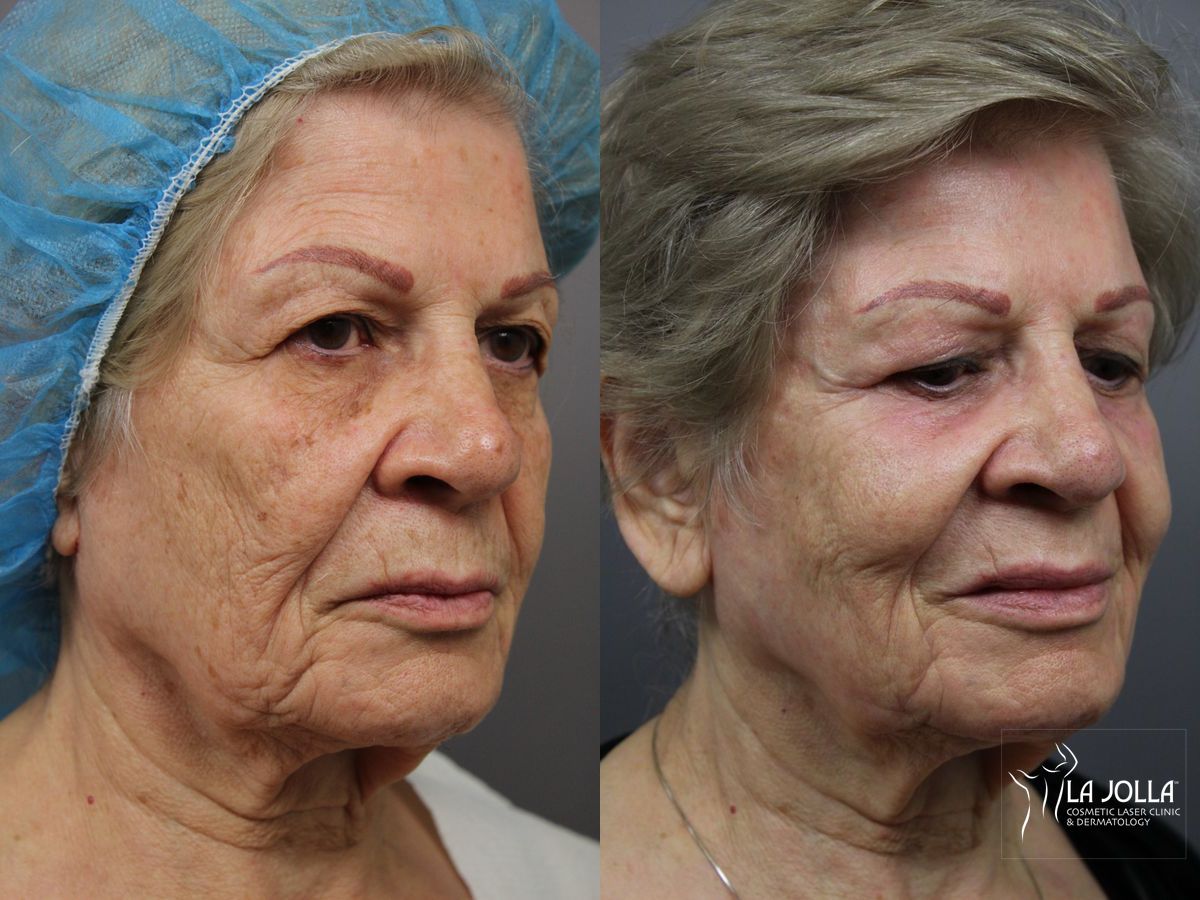 Before and after SP Dynamis case 36367