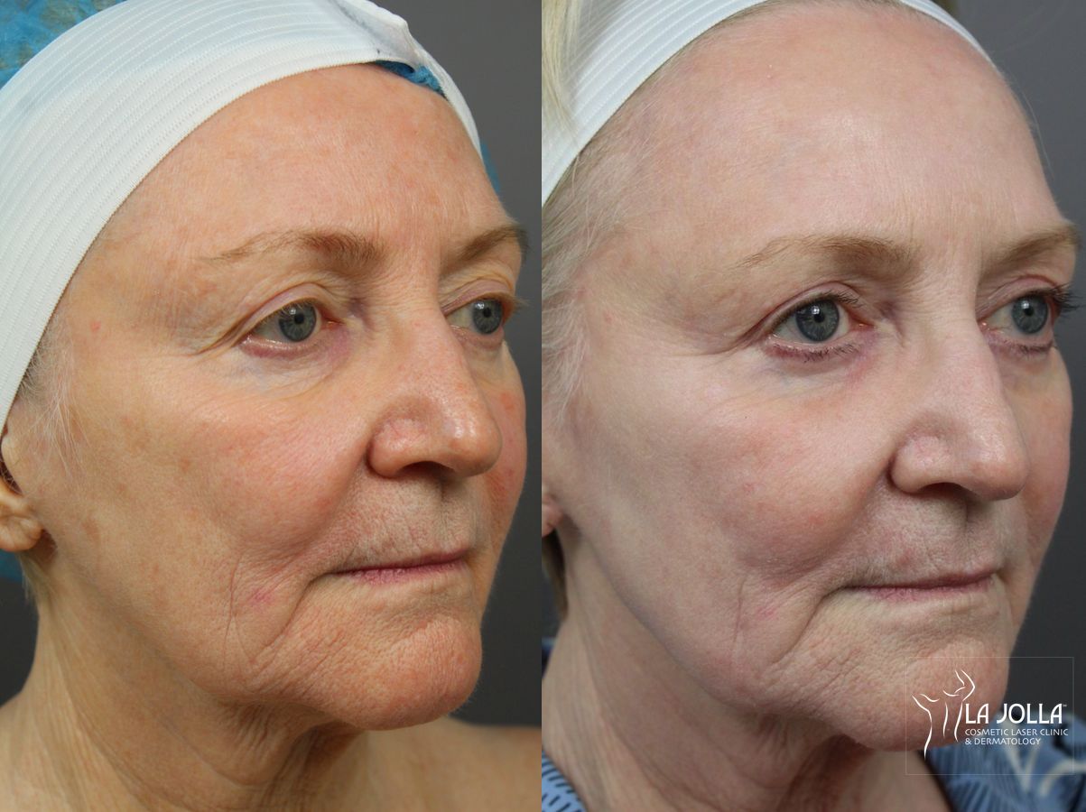 Before and after SP Dynamis case 36262 - Angle 3