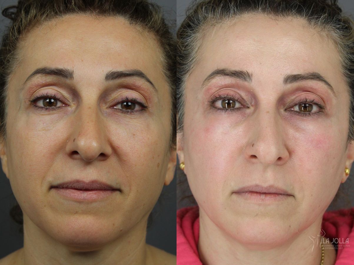 Before and after SP Dynamis case 36376