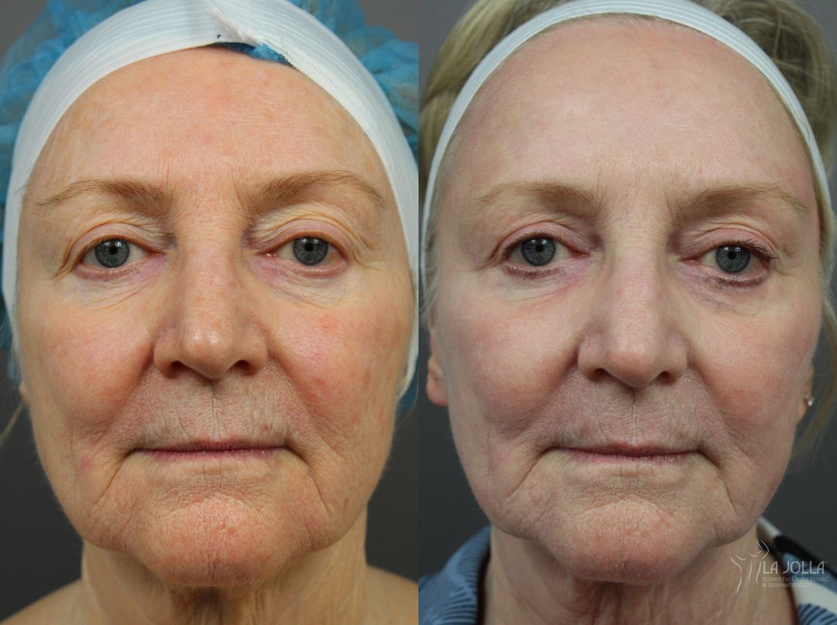 Before and after SP Dynamis case 36262 - Angle 2