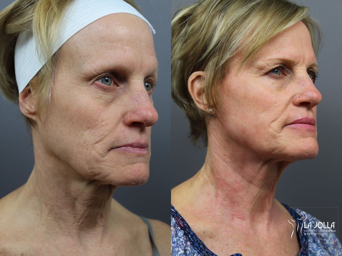 Before and after SP Dynamis case 36307