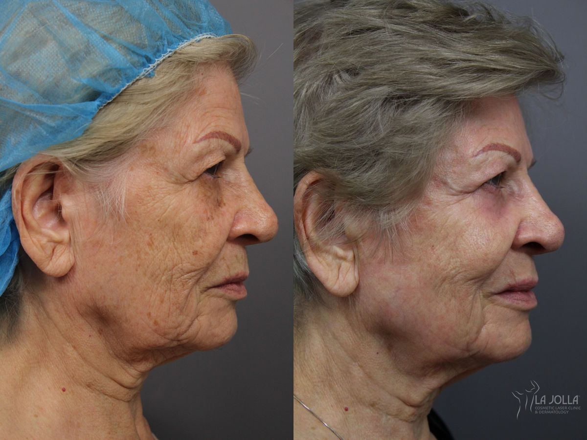Before and after SP Dynamis case 36369