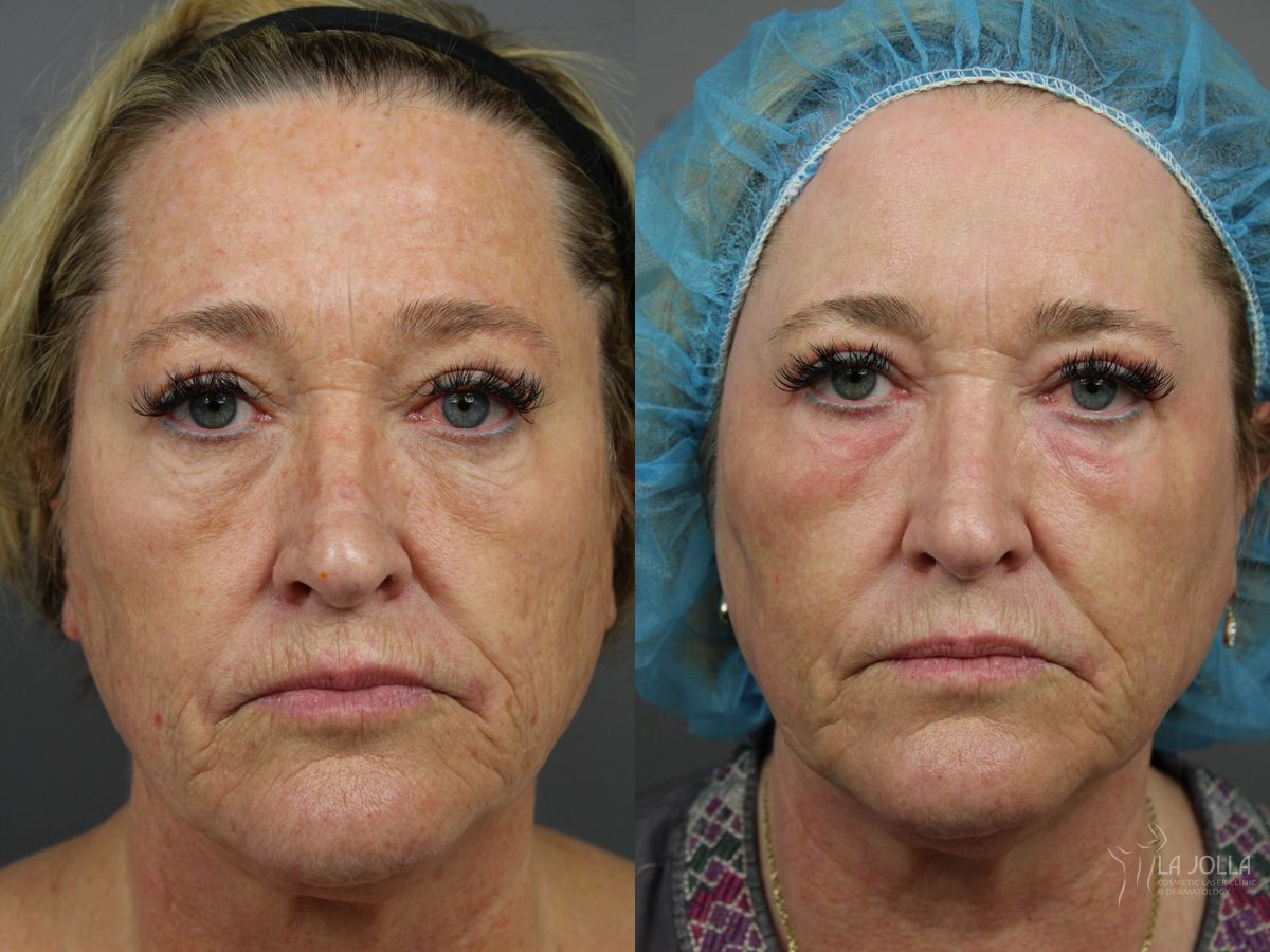 Before and after SP Dynamis case 36335