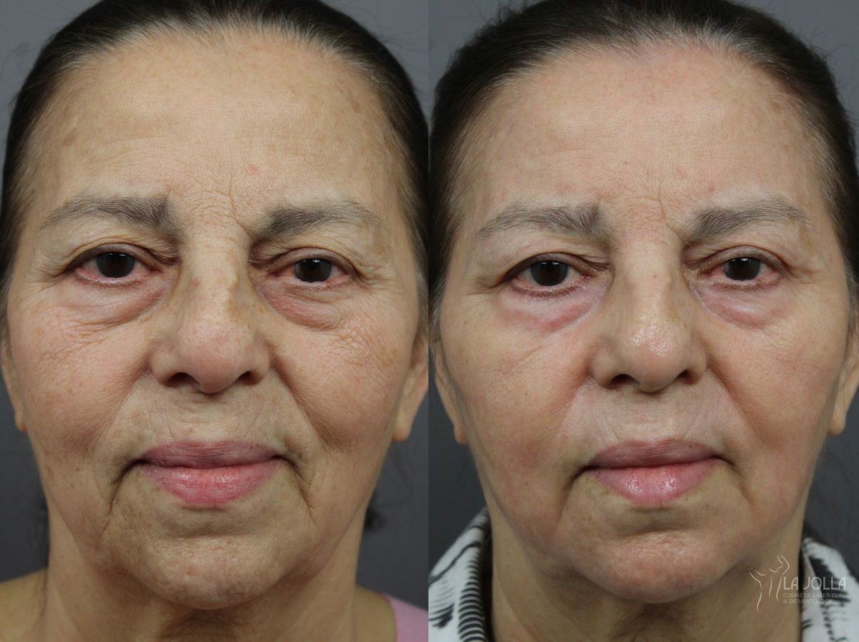 Before and after SP Dynamis case 36283 - Angle 2
