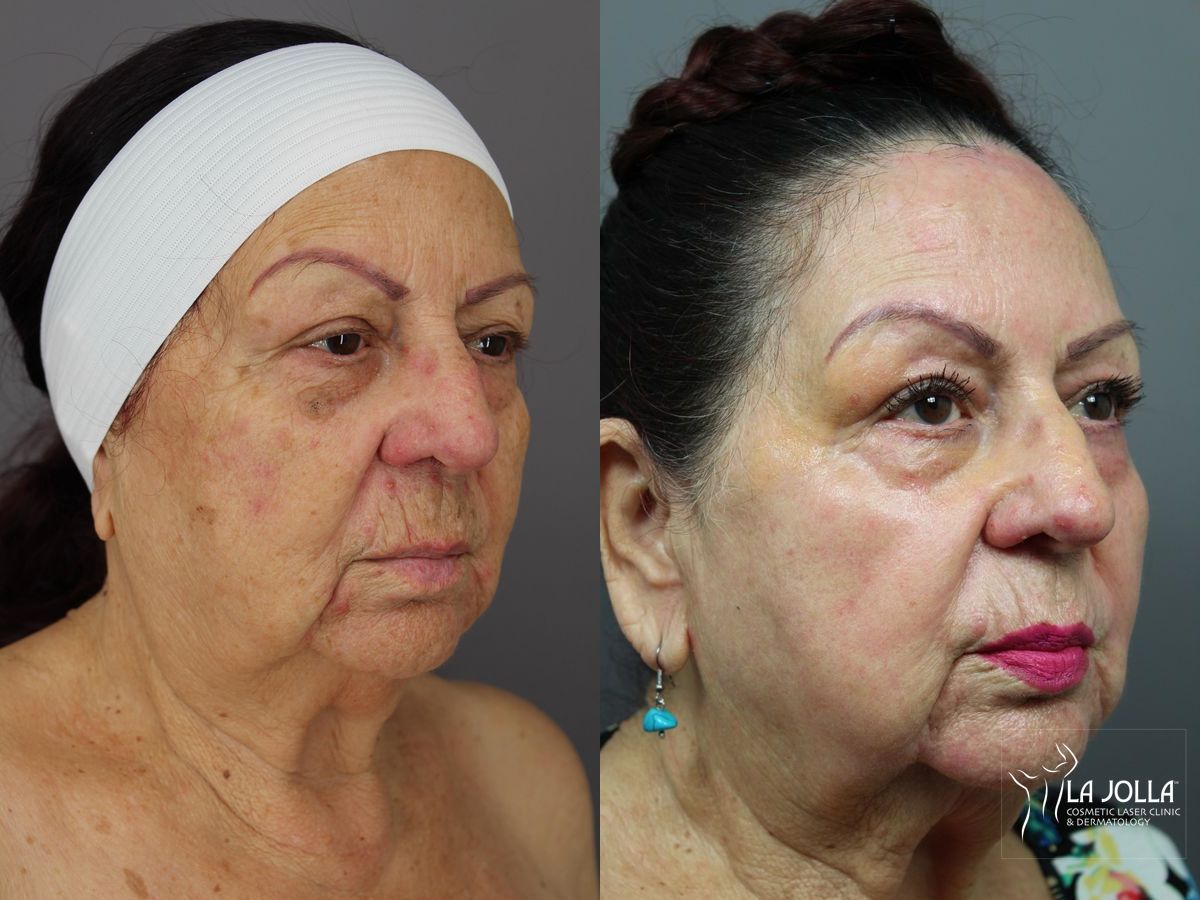 Before and after SP Dynamis case 36352