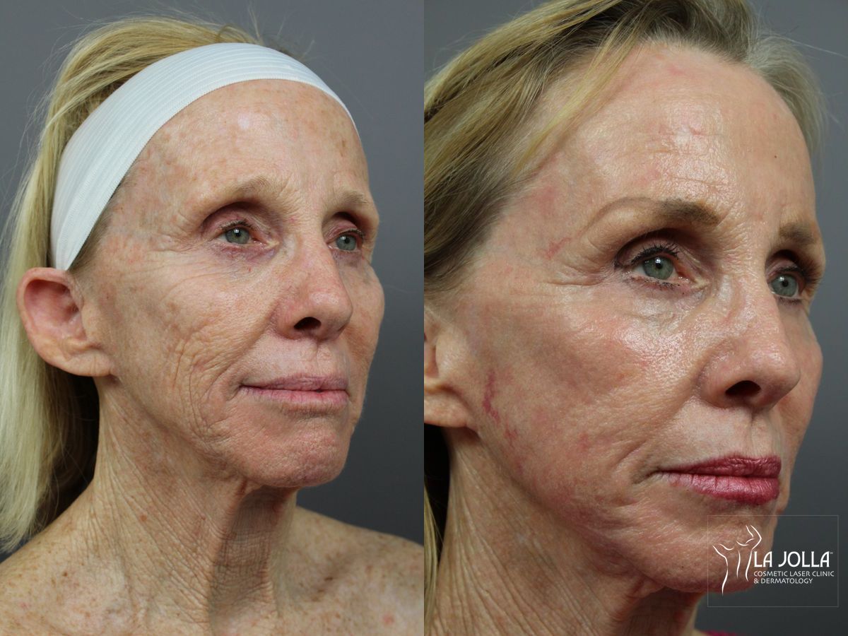 Before and after SP Dynamis case 36371