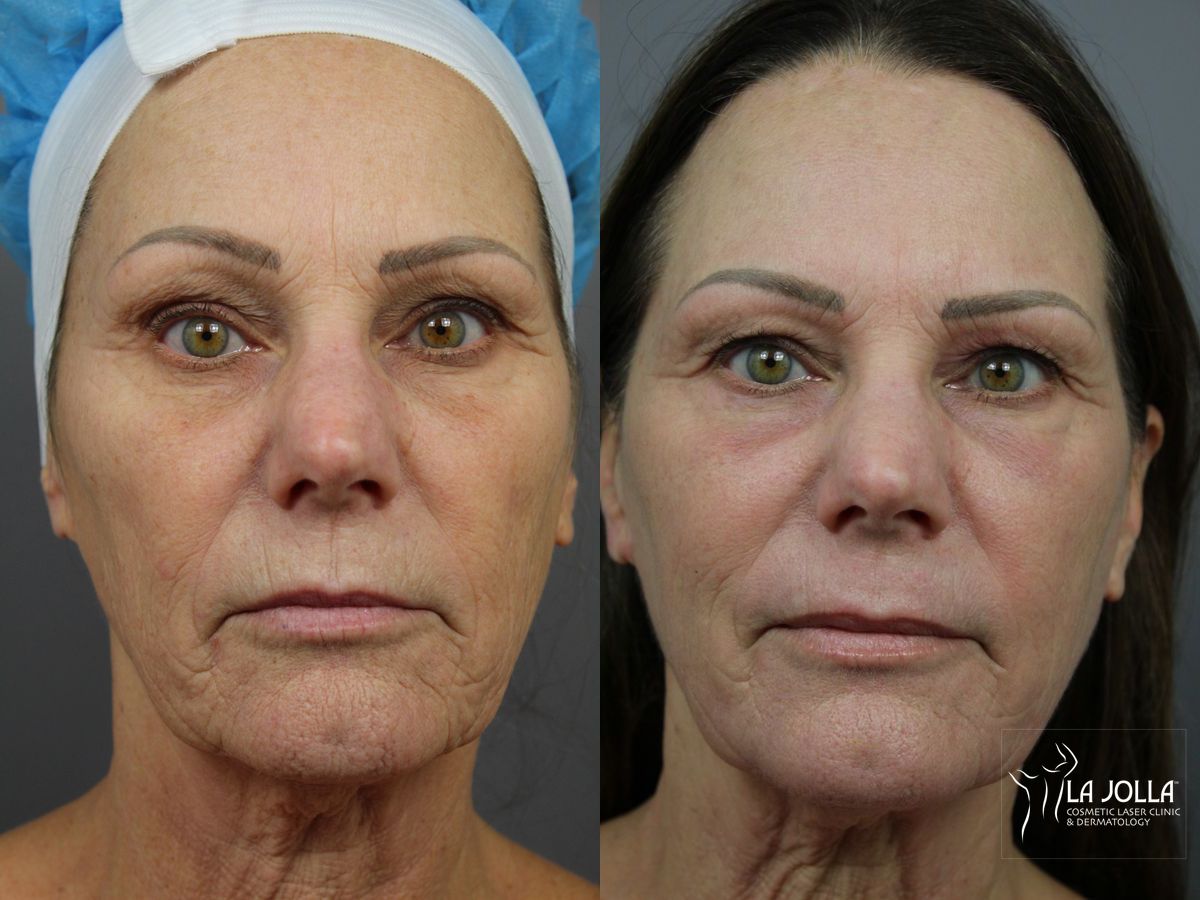 Before and after SP Dynamis case 36358
