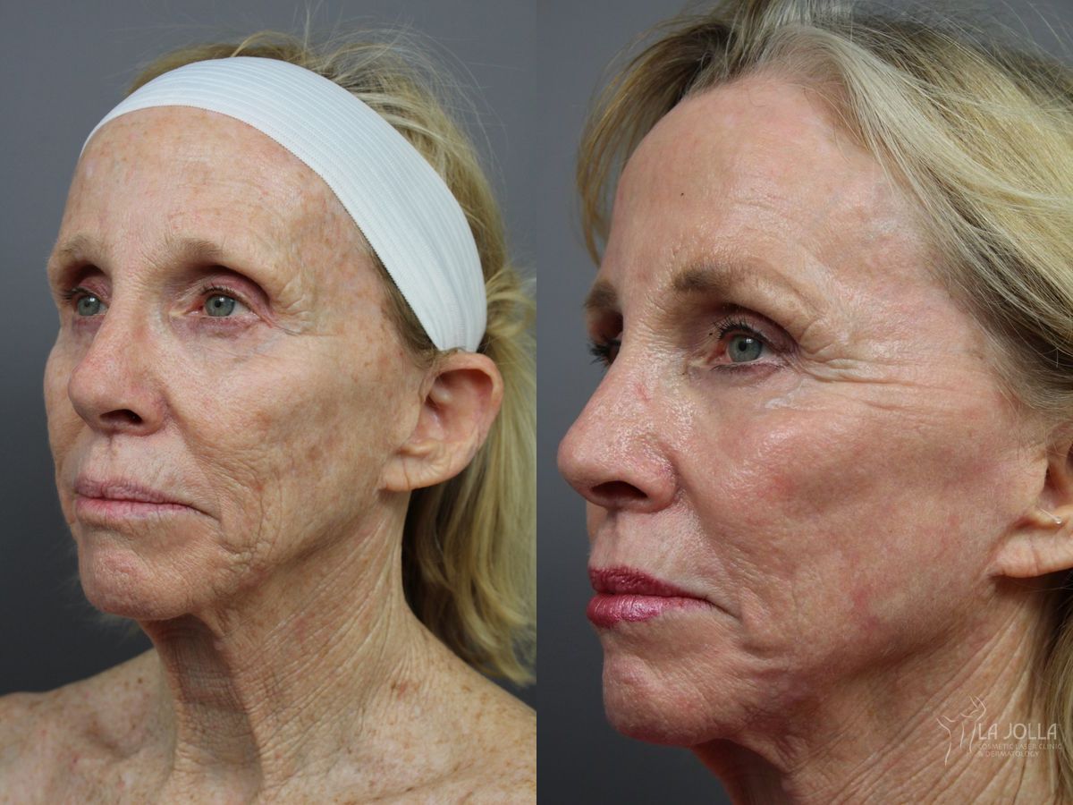 Before and after SP Dynamis case 36370