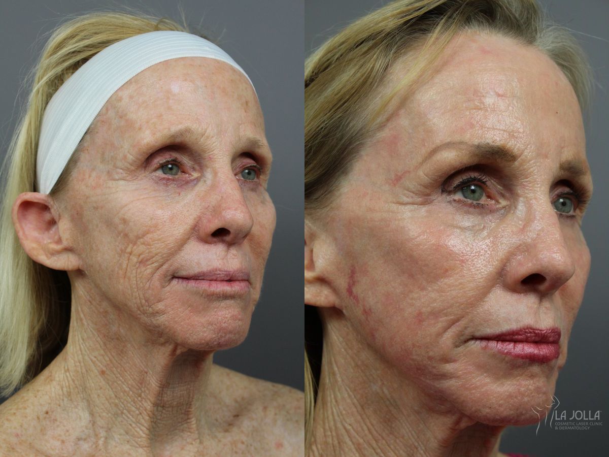 Before and after SP Dynamis case 36371