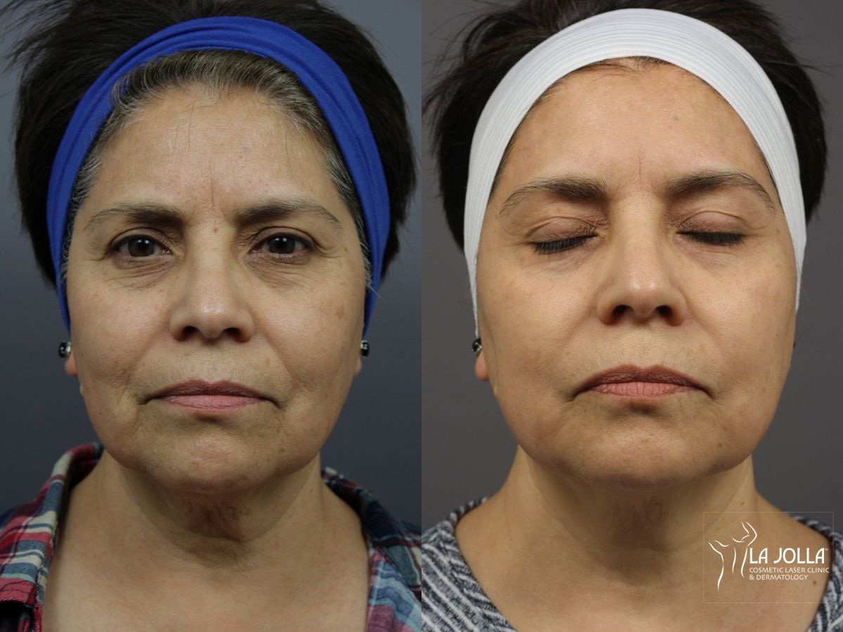 Before and after SP Dynamis case 36361